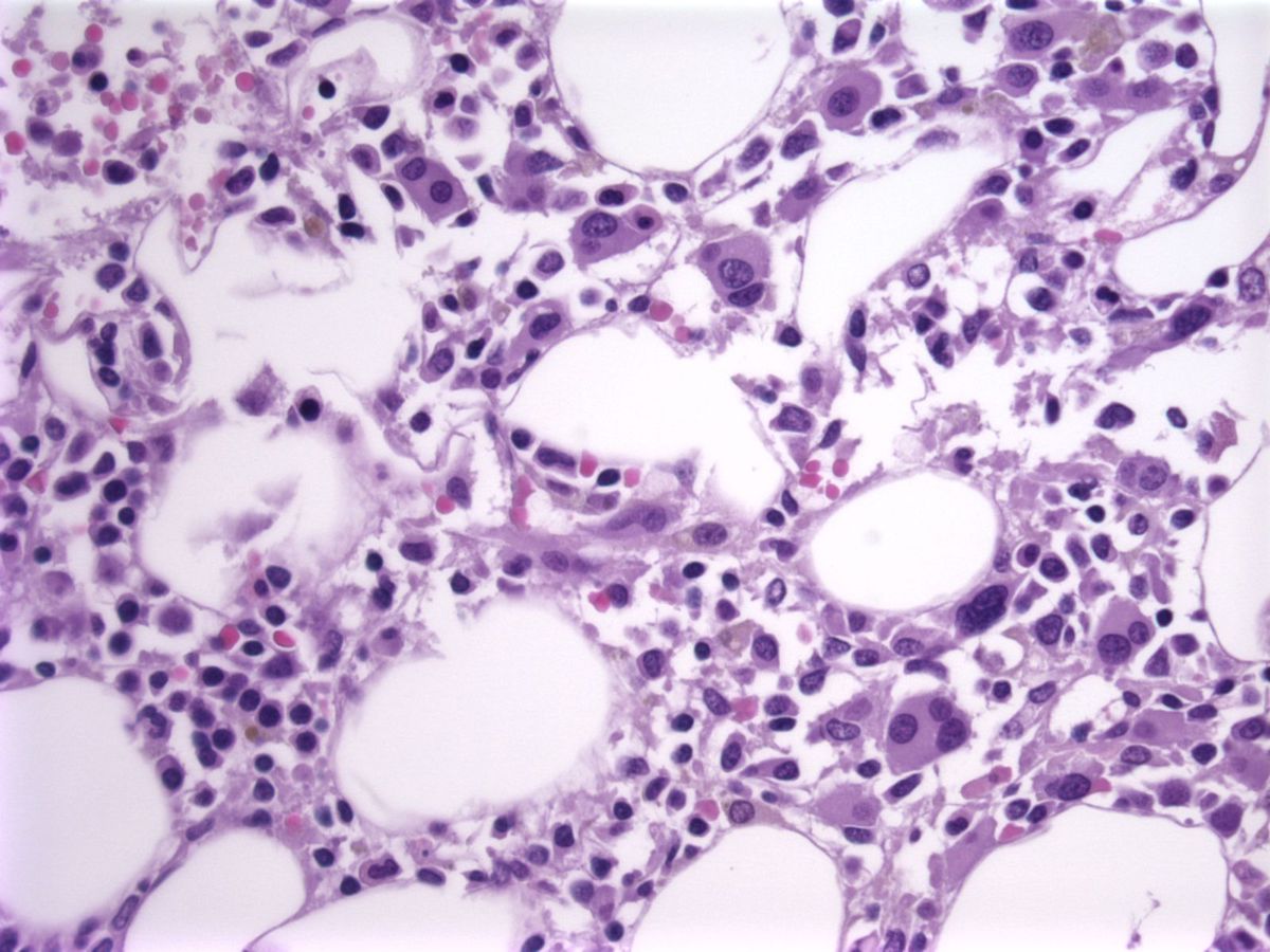 bone marrow biopsy, H&E; abnormal megakaryocytes and increased blasts